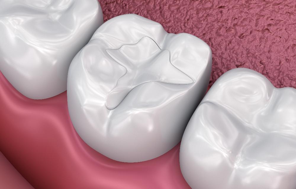 close up of filling in tooth | tooth-colored fillings brooklyn