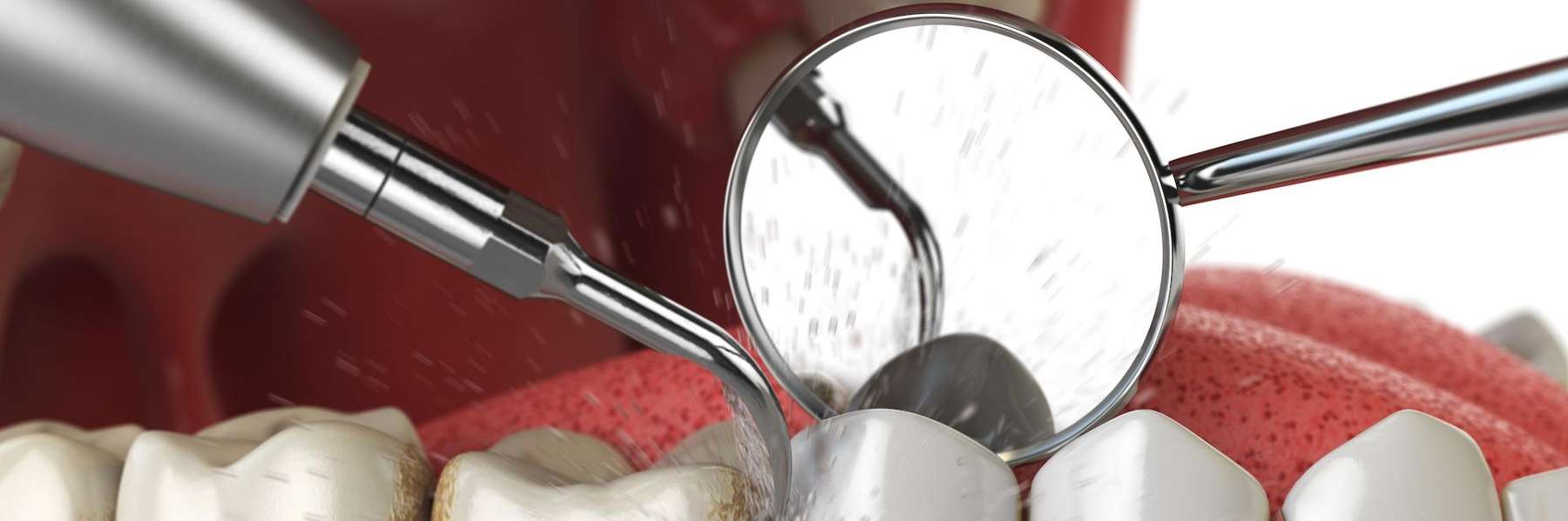 An illustration of a dental cleaning