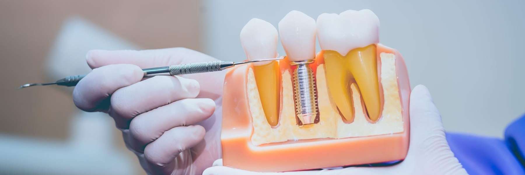 A dentist holding a dental implant model