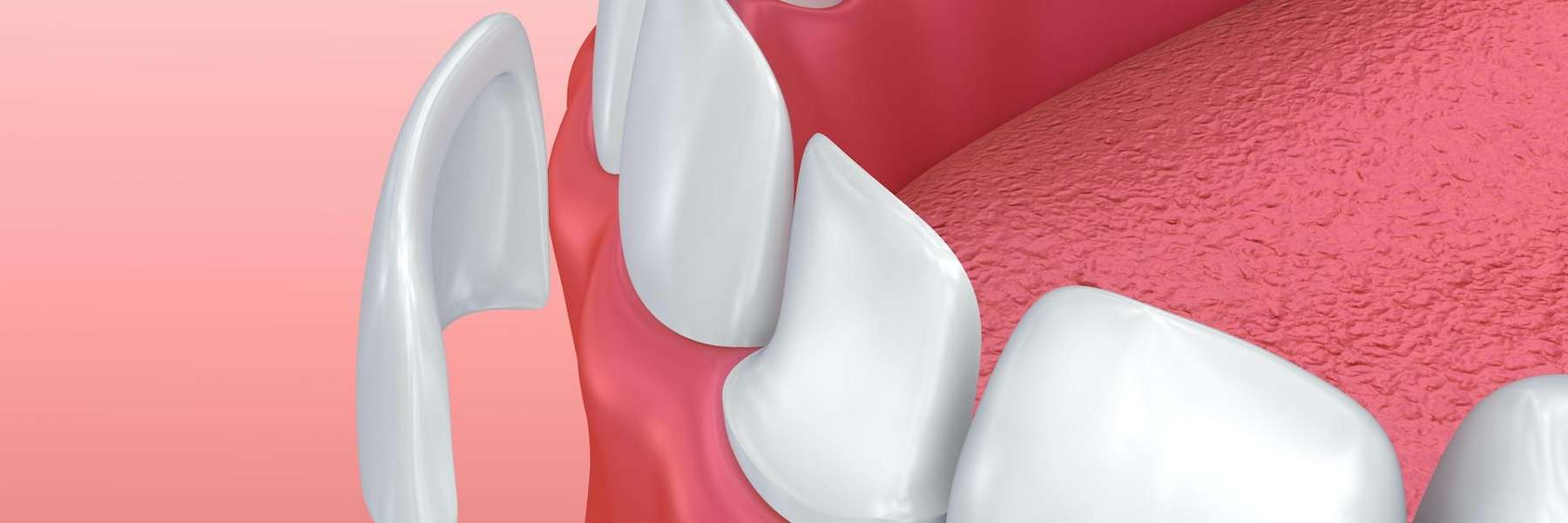 veneer going on bottom tooth | best dentist dumbo ny