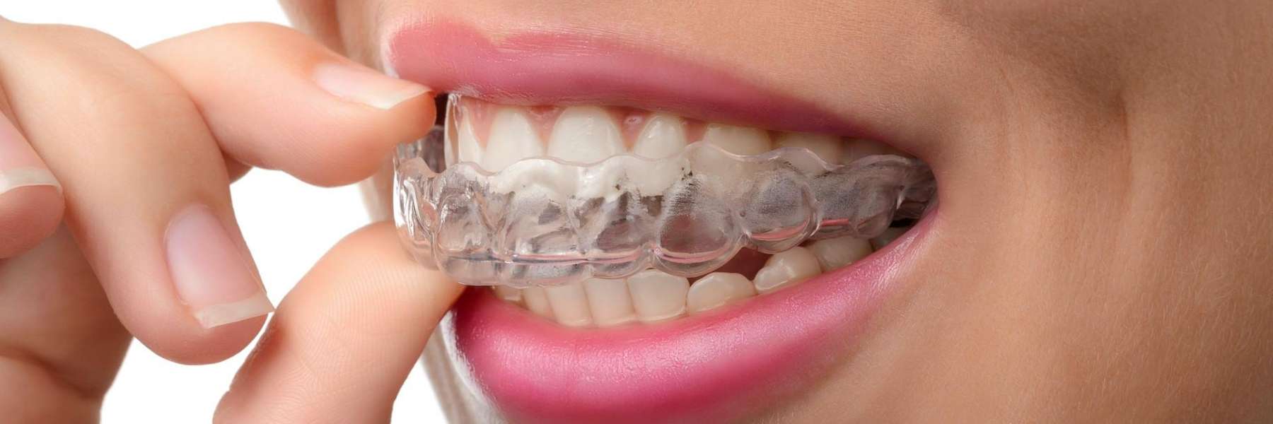 patient putting in invisalign | dumbo dental care 11201