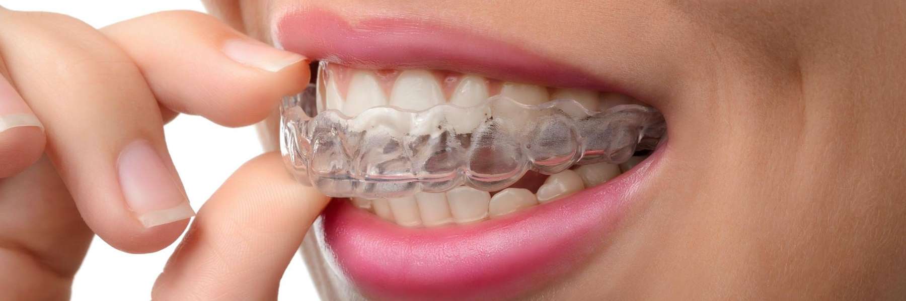 A woman putting in her Invisalign tray