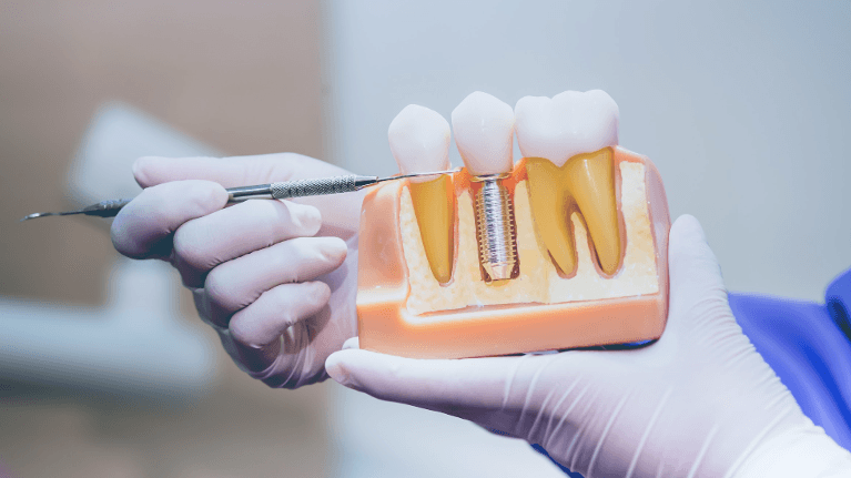 dental implant model | Brooklyn Dentist