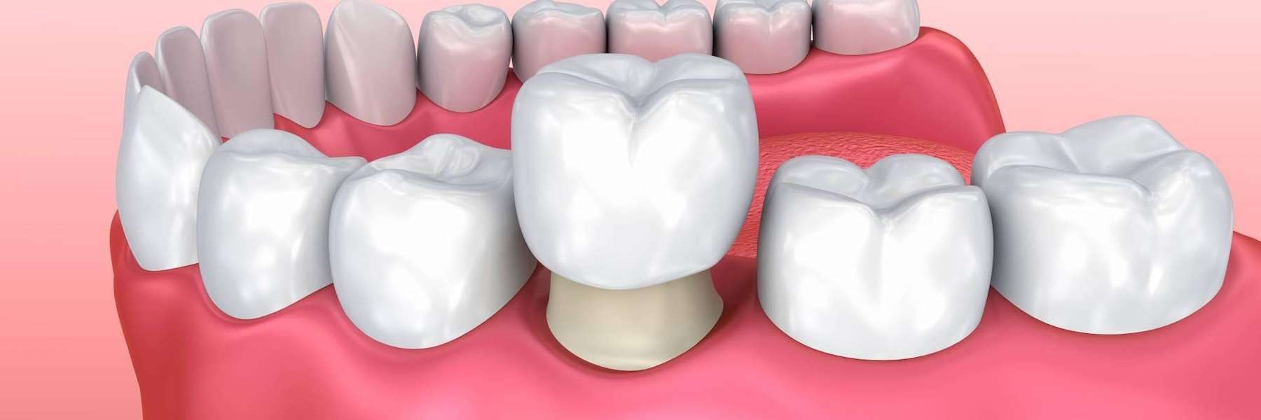 close up of dental crown | dental crowns 11201
